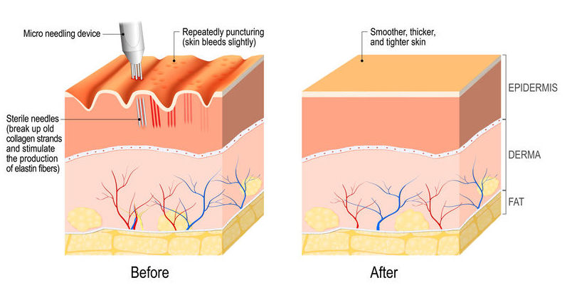 hair loss